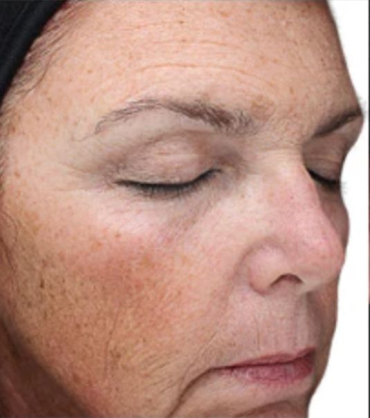 Medium Depth Chemical Peel Treatment for Acne Scars Before