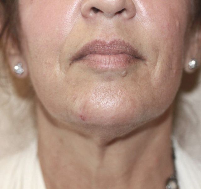 Facial Contouring and Lifting Treatment - After