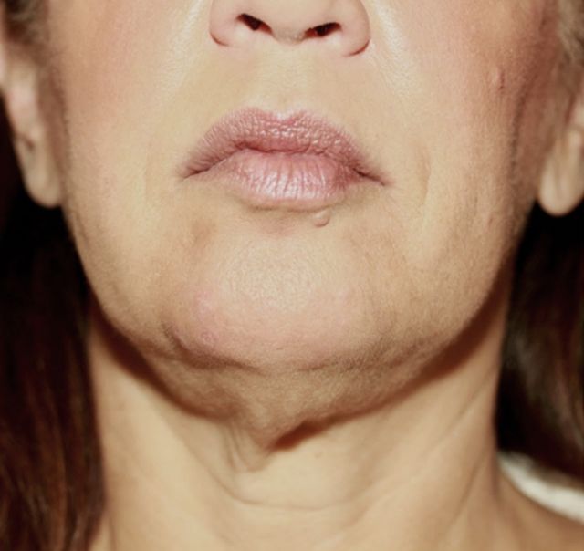 Facial Contouring and Lifting Treatment - Before
