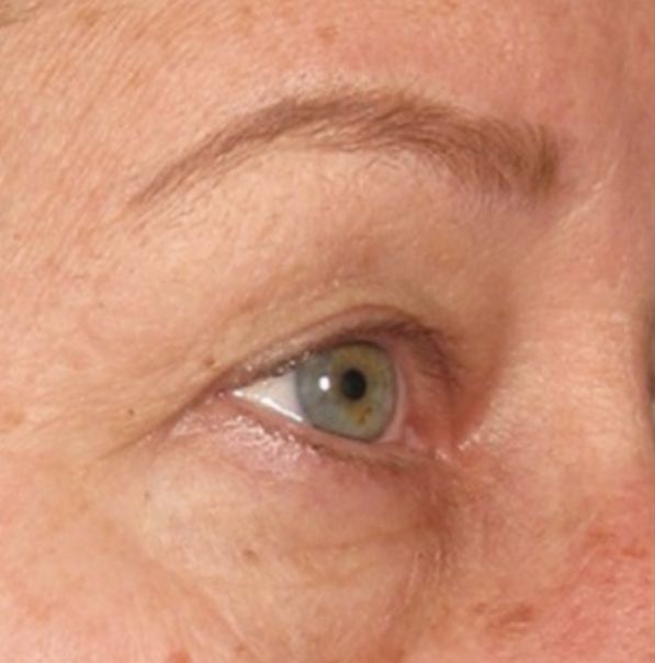 Viora VST Laser Skin Treatment - After