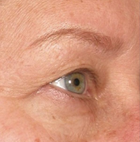 Viora VST Laser Skin Treatment - Before