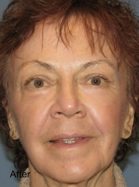 Fractional Laser Resurfacing Treatment - After 