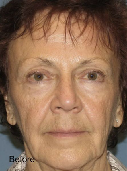 Fractional Laser Resurfacing Treatment - Before