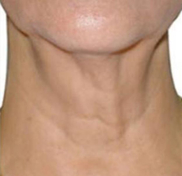 Microneedling With Radiofrequency for Neck - After