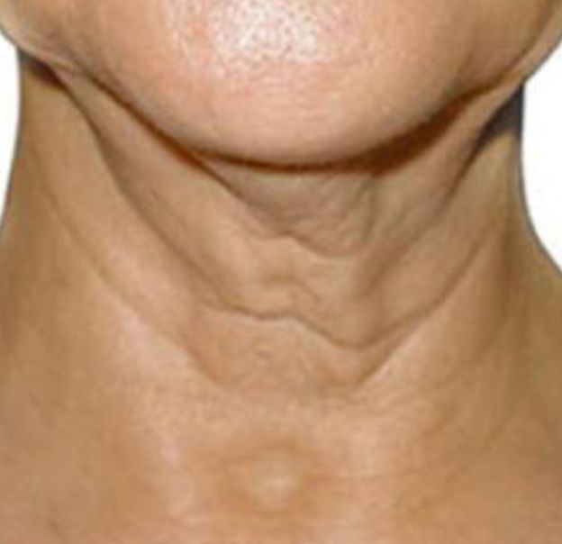 Microneedling With Radiofrequency for Neck  - Before