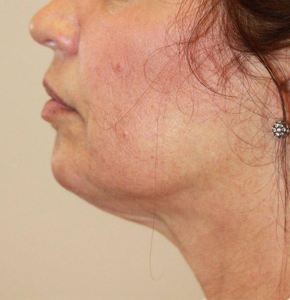 Skin Tightening Treatment - After