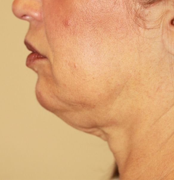 Skin Tightening Treatment - Before