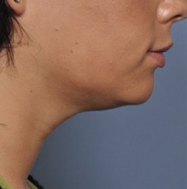 Viora VST Treatment For Chin, Jaw, & Neck Rejuvenation - After