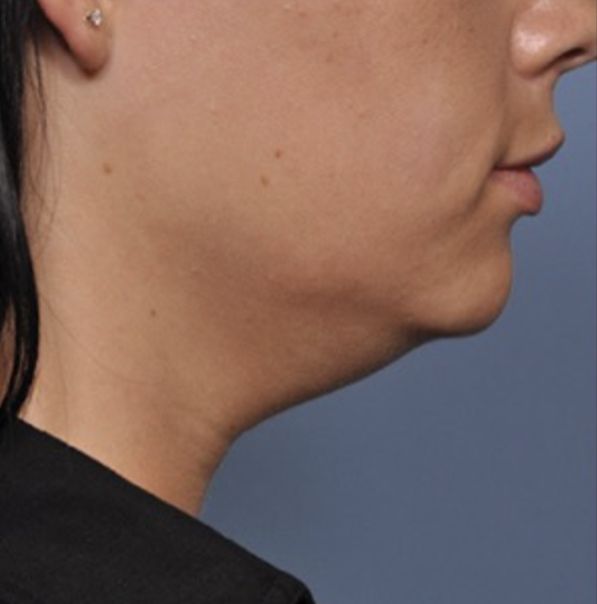 Viora VST Treatment For Chin, Jaw, & Neck Rejuvenation - Before