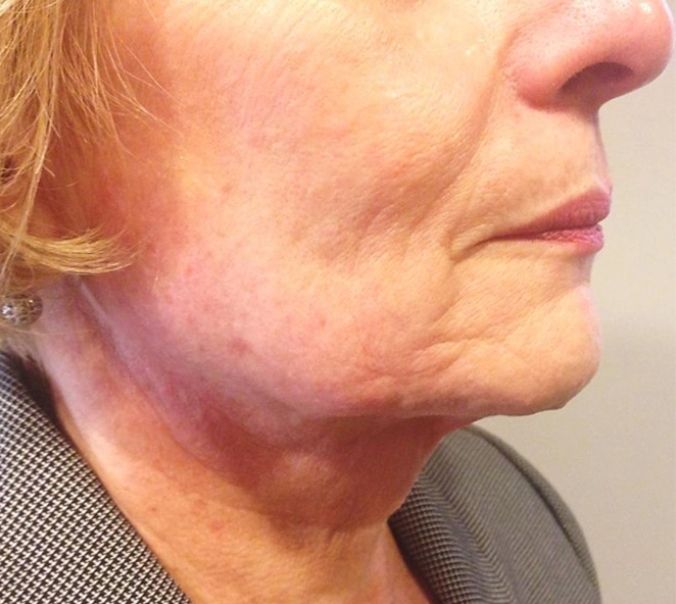 ReLift Facial Contouring and Lifting - After