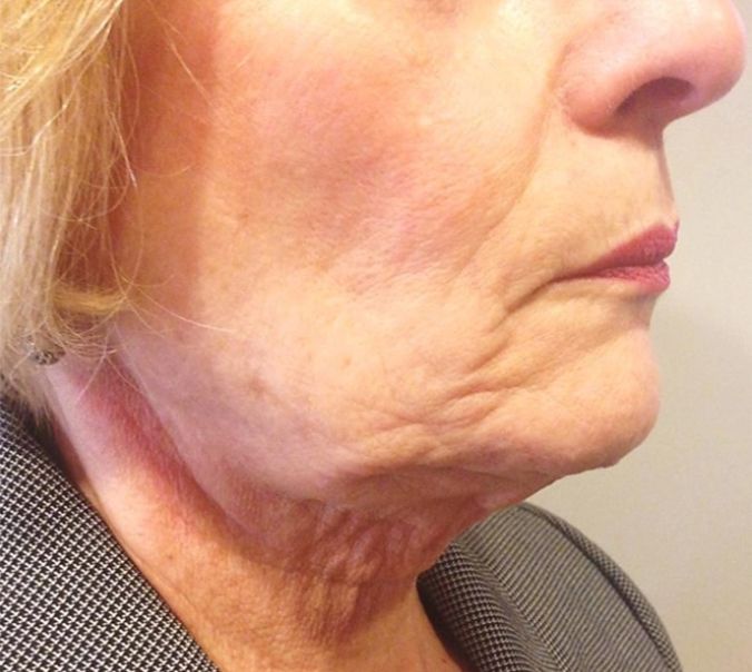 ReLift Facial Contouring and Lifting - Before