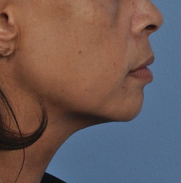 Viora VST Skin Tightening for Neck - After 