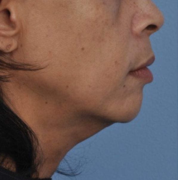 Viora VST Skin Tightening for Neck - Before 