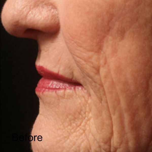 Laser Skin Treatment - Before