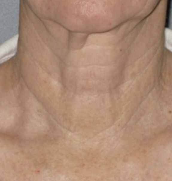 Viora VST Neck Tightening and Skin Rejuvenation - After