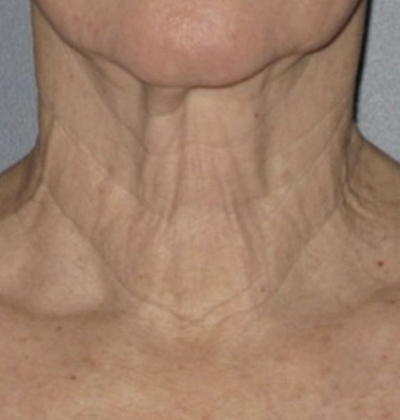 Viora VST Neck Tightening and Skin Rejuvenation - Before