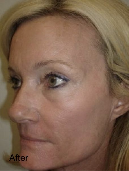 Facial Laser Treatment - After