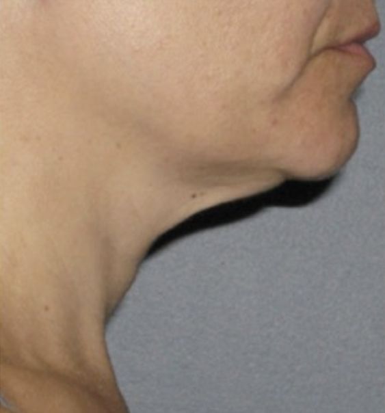 Viora VST Tightening for Double Chin - After