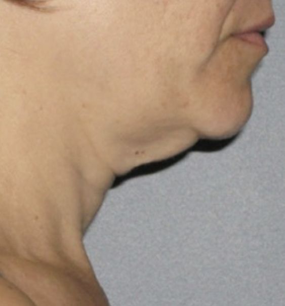 Viora VST Tightening for Double Chin - Before