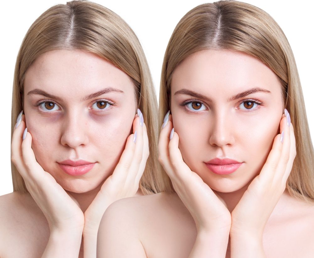 How Do You Get Dark Circles Under Your Eyes to Go Away?
