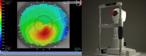 Corneal Topograph