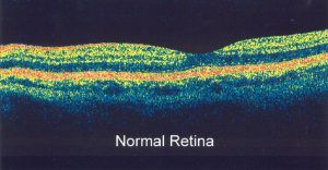 Corneal Topograph