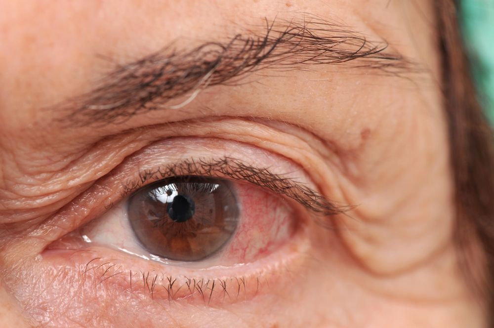 Is Chronic Redness a Sign of Dry Eye Syndrome?