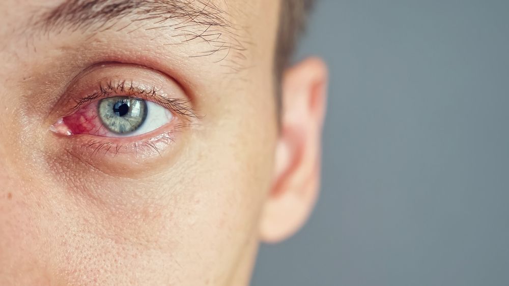 Can Dry Eye Cause Excessive Blinking?