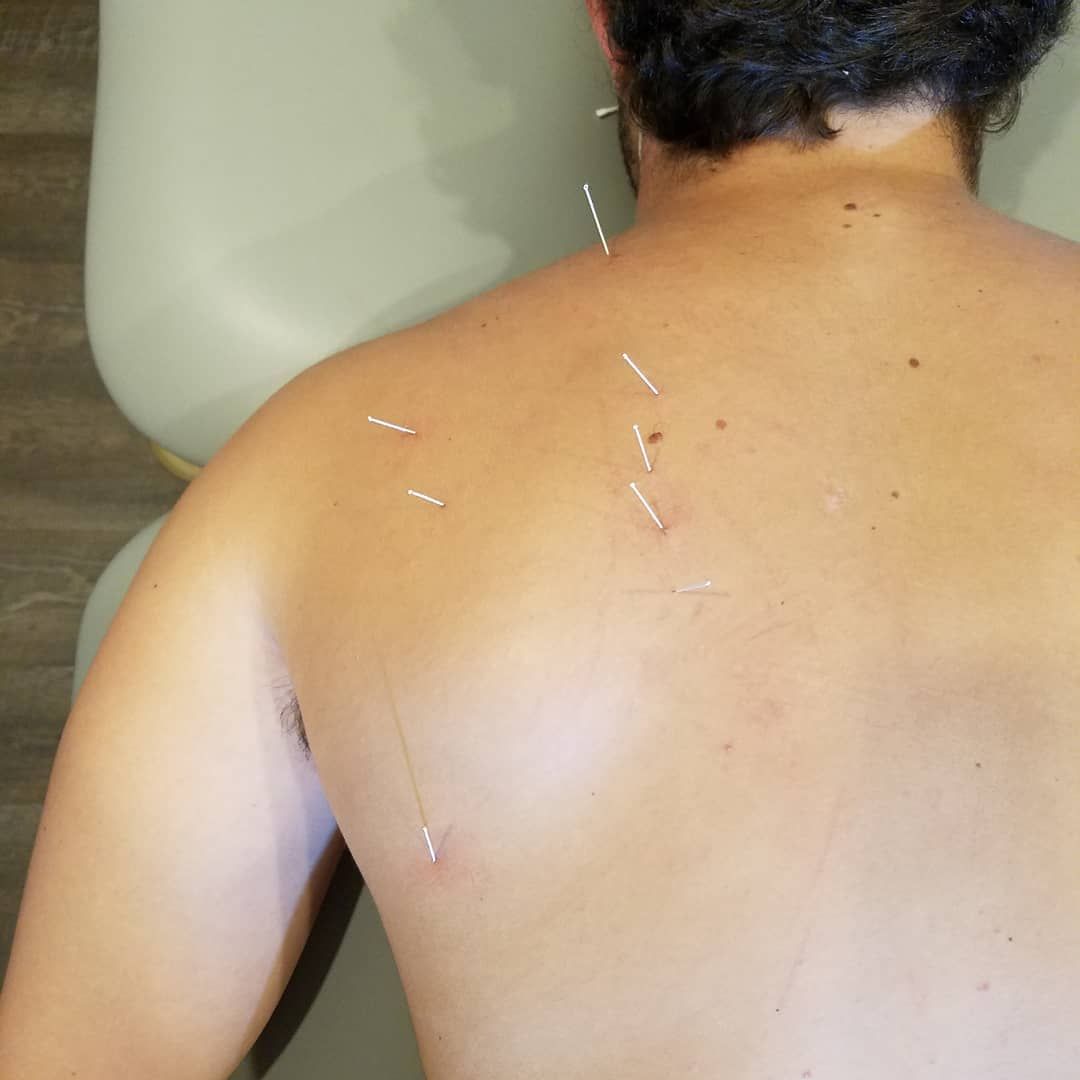 dry needling