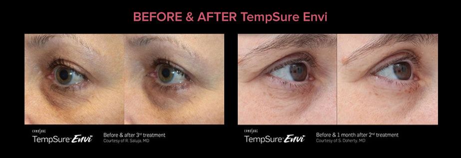 before and after dry eye treatment