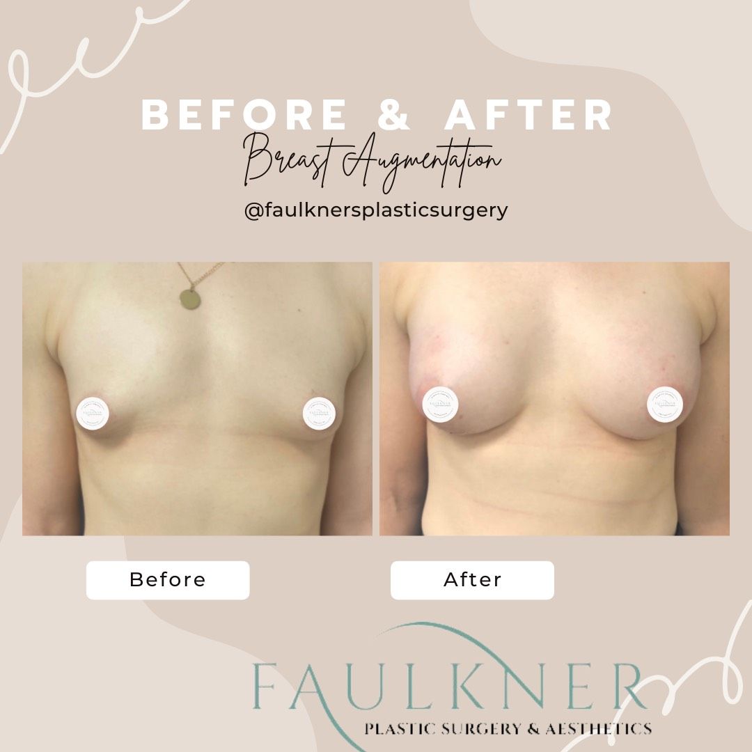 Breast lift North Bethesda