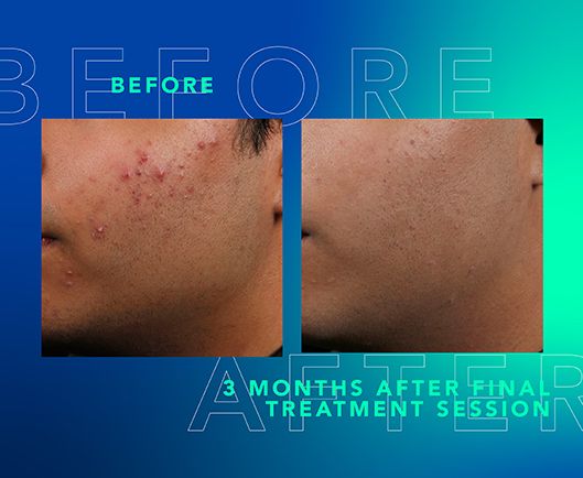 Before and After AviClear treatment