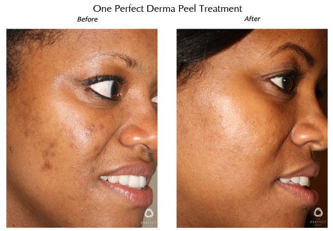 dermal peel treatments