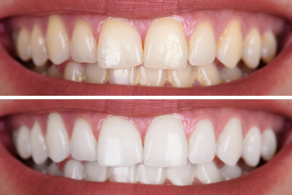 Close-up Of A Smiling Woman's Teeth Before And After Whitening