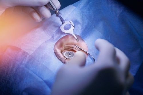 Cataract Surgery: What to Expect and Tips for a Smooth Healing Process