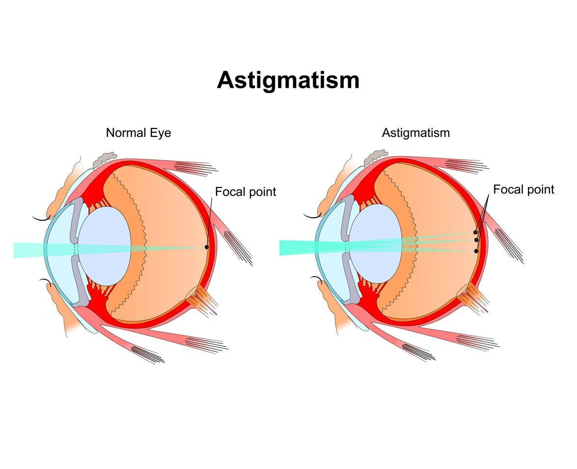 viziunea 8 astigmatism)