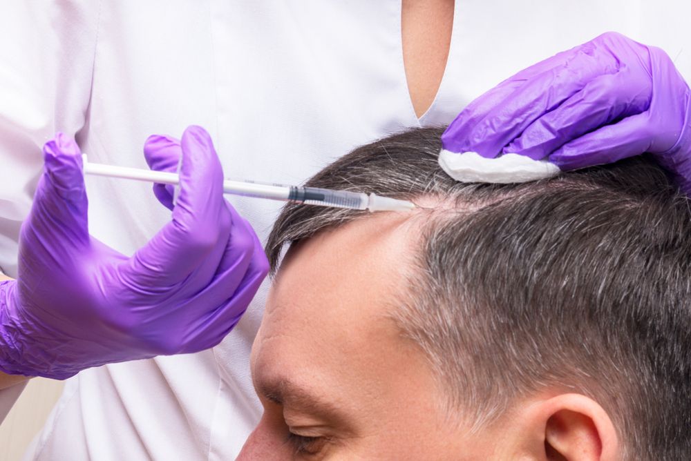 PRP Therapy for Hair Restoration