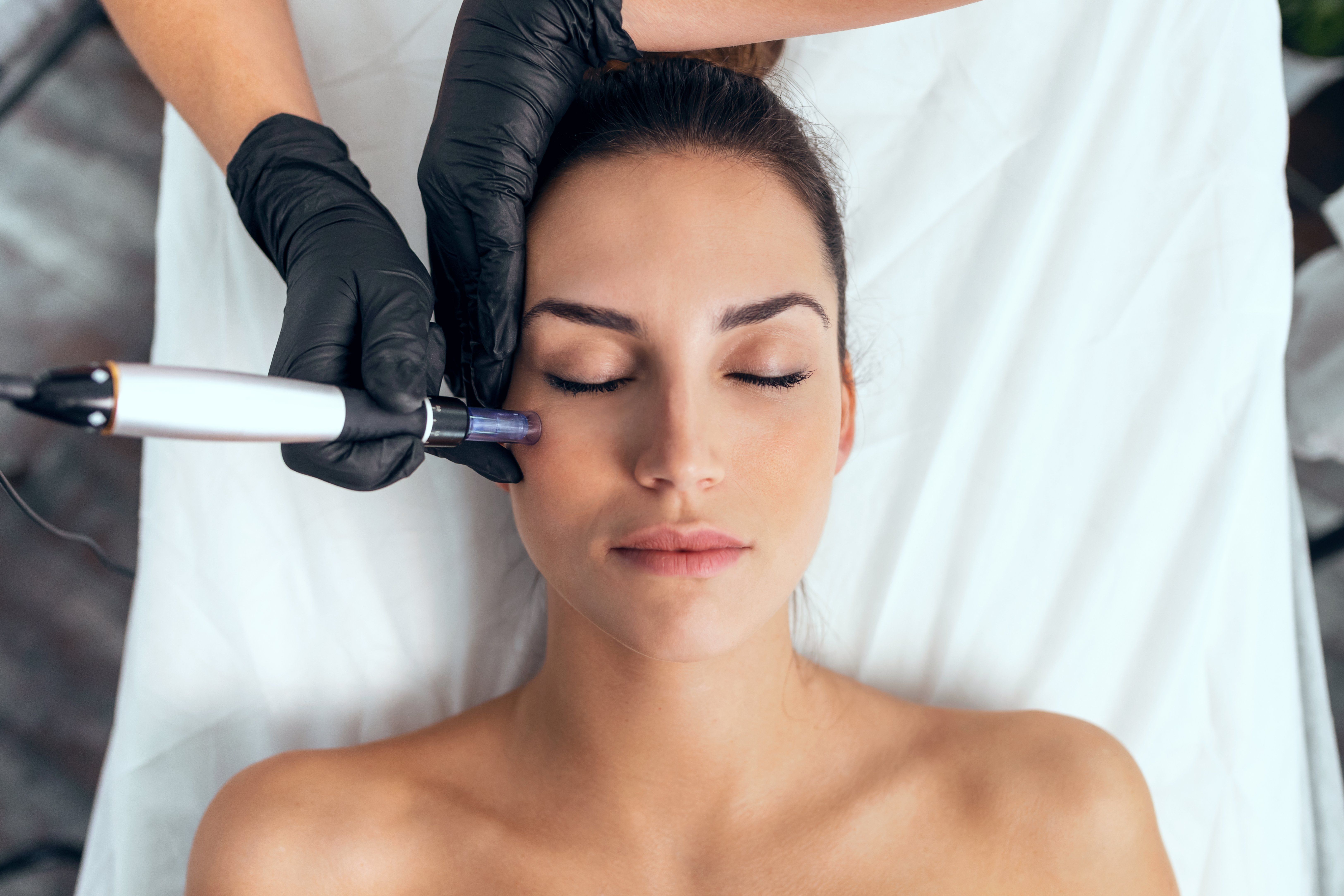 What Are the Benefits of Microneedling?