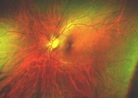 Retinal Imaging