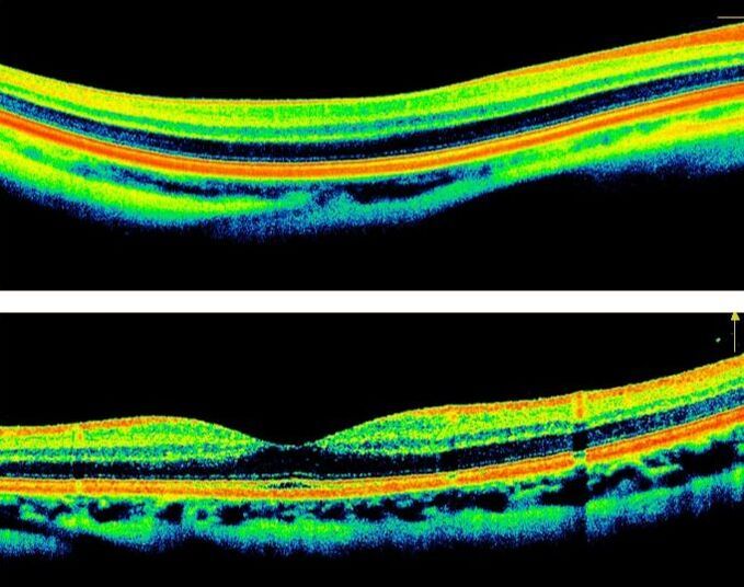 Retinal Imaging