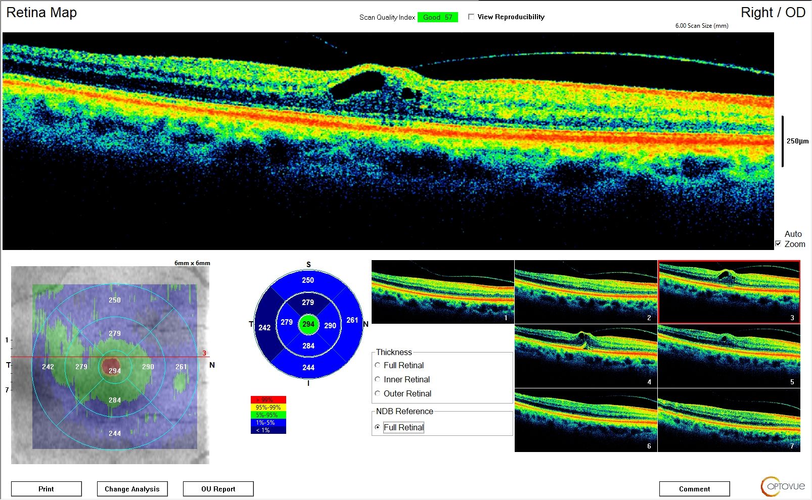 Retinal Imaging