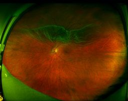 Retinal Imaging