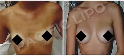 Breast Implant Before and After