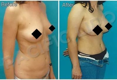 Breast Implant Before and After 2