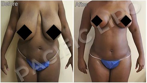 Breast Lift Mastopexy, Full Lift Beverly Hills