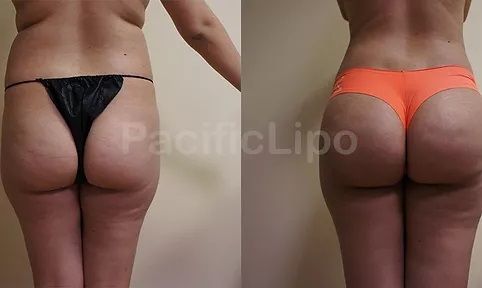 Before and After Butt Lift
