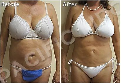 Lipo Correction