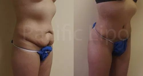 Tummy Tuck Before and After