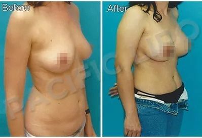Breast Implant Before and After 2