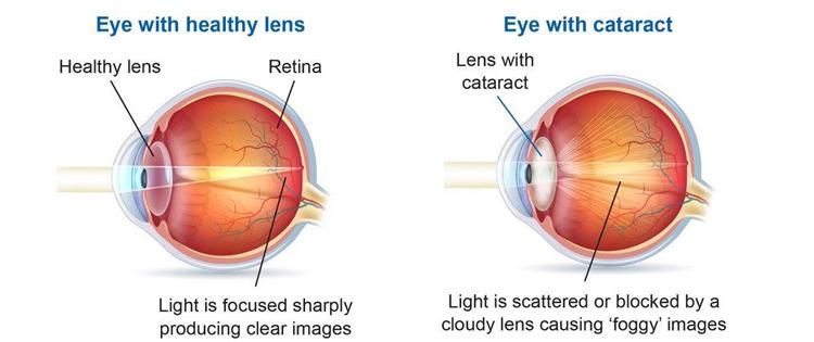 Cataracts and Cataract Surgery: A Simple Explanation from Your Eye Doctor